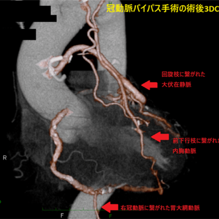 冠動脈とは|産業医科大学 医学部 心臓血管外科