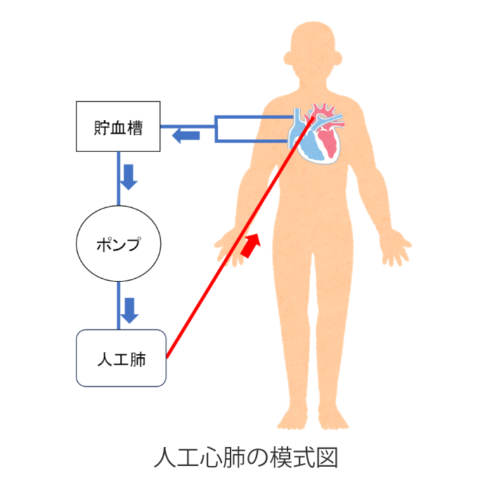 人工心肺の模式図|産業医科大学 医学部 心臓血管外科