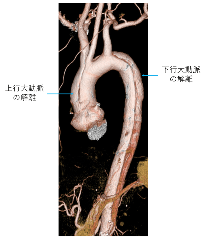 急性A型大動脈解離|産業医科大学 医学部 心臓血管外科