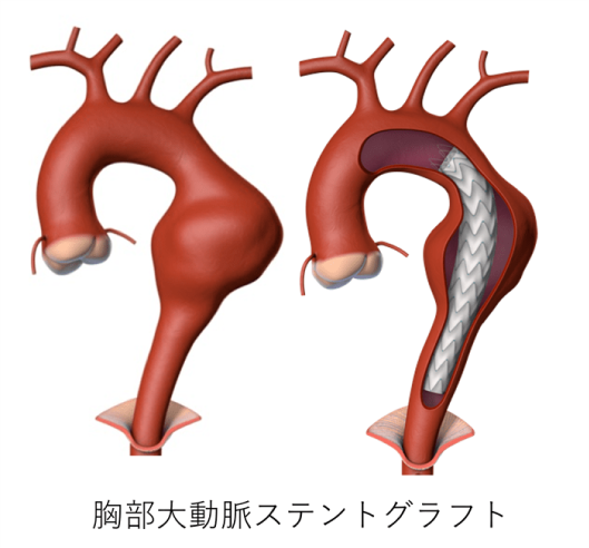 ステントグラフト手術|産業医科大学 医学部 心臓血管外科