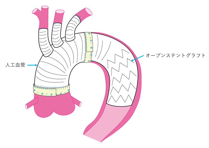 ハイブリッド手術|産業医科大学 医学部 心臓血管外科