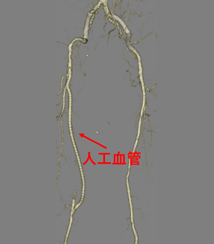 図3|末梢血管疾患|産業医科大学 医学部 心臓血管外科