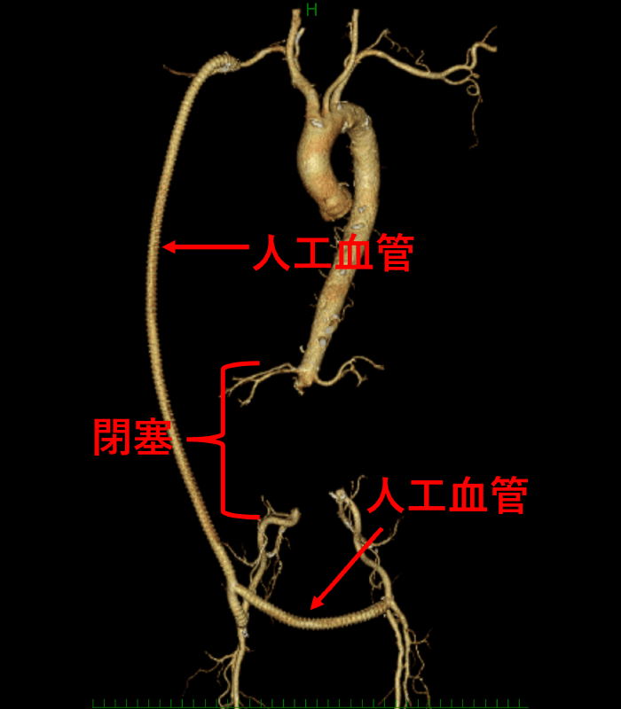 図4|末梢血管疾患|産業医科大学 医学部 心臓血管外科